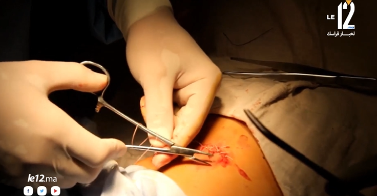 بالفيديو..مستشفى الحسن الثاني بأكادير يجري عمليات جراحية مجانية لفائدة مرضى السرطان
