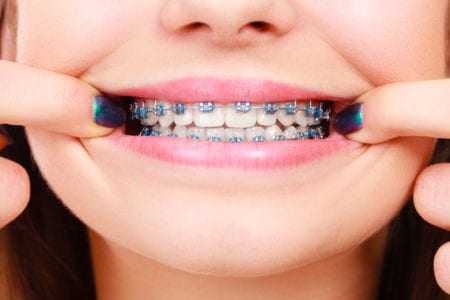 نصائح طبية لاجتناب آلم ” تقويم الاسنان”