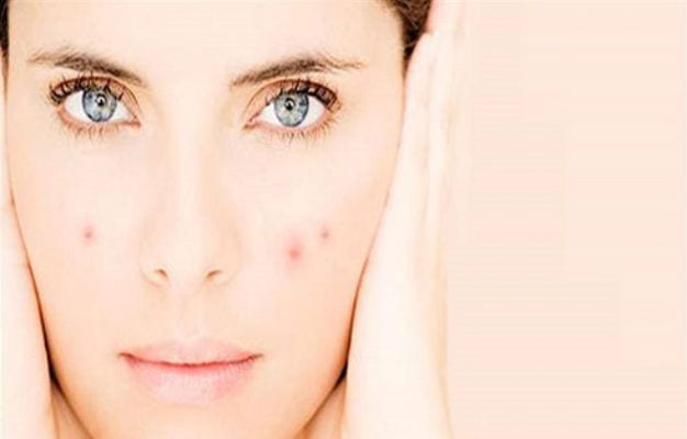 سيدتي..اتبعي هذه الطرق للتخلص من البثور في الصيف