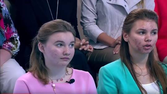 حب الشباب قد يظهر في الثلاثين من العمر