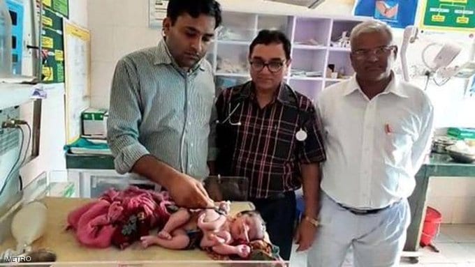 سبحان الله.. ولادة طفلة بأربع أرجل و3 أياد
