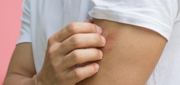 طرق طبيعية للسيطرة على الالم “لذغة الباعوض”