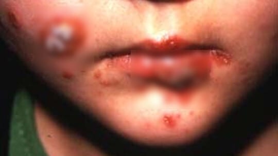 ميدلت. استنفار بعد إصابة تلاميذ بمرض “غريب”