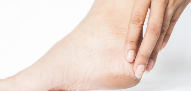 سيدتي. وصفات منزلية سهلة للتخلص من مشكلة تشقق القدمين