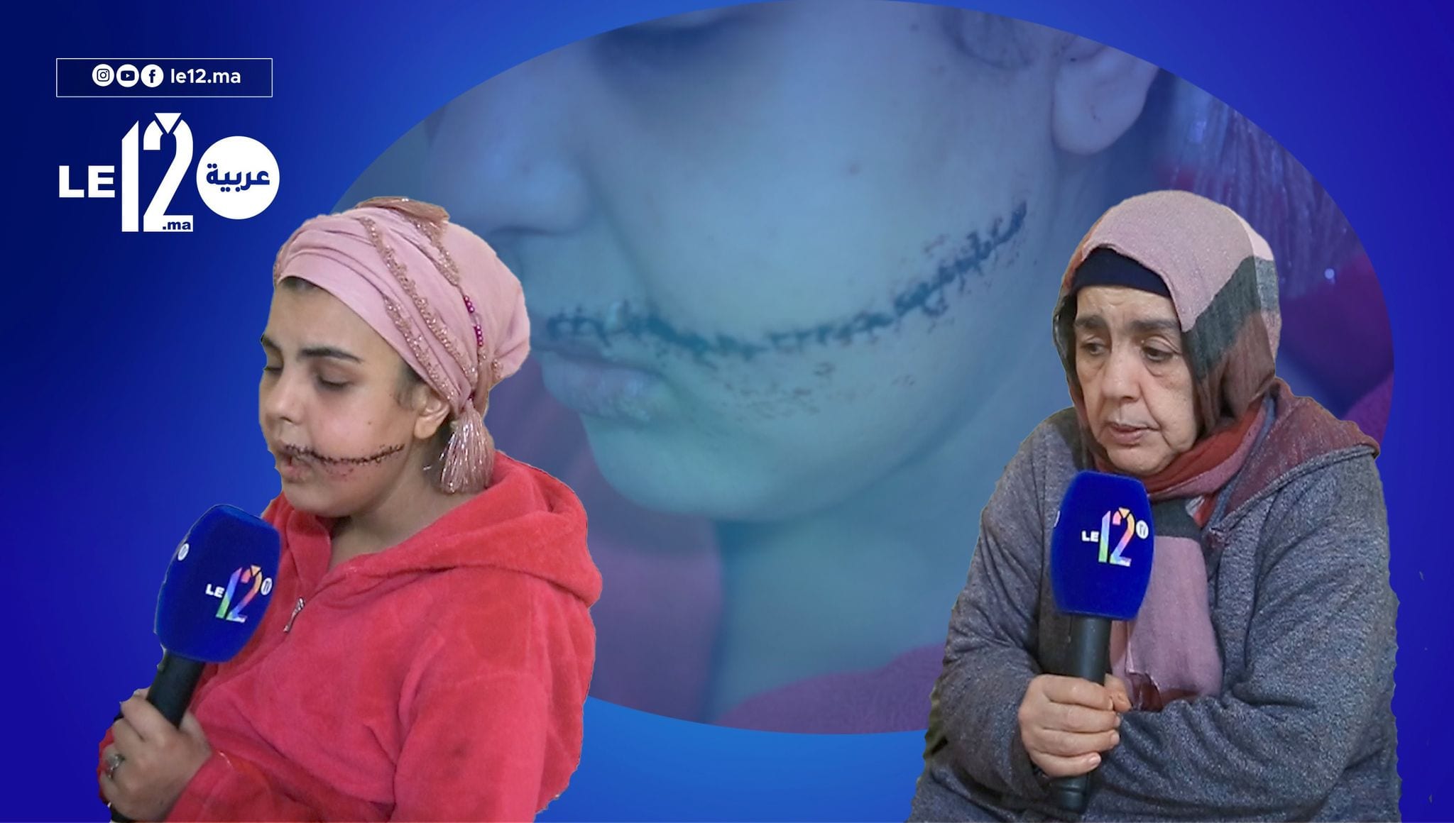 الحكرة في القنيطرة.. يتيمة جميلة خسروا ليها وجهها