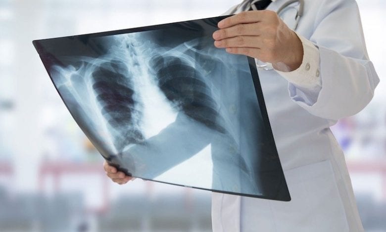 وزارة آيت الطالب تكشف عن عدد المصابين بداء السل بالمغرب  